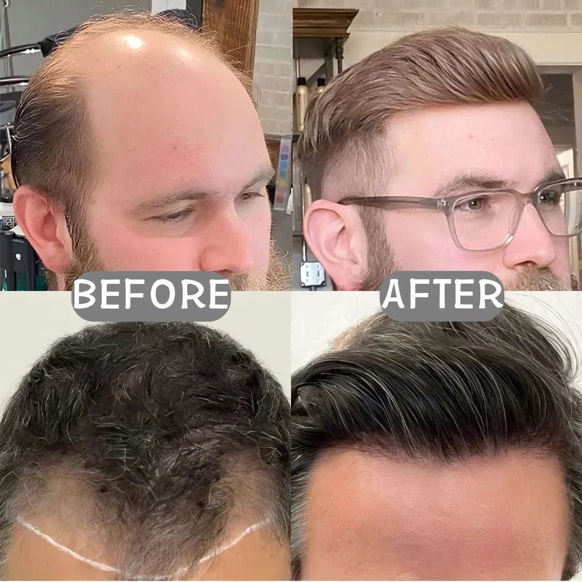 Men's forehead hairline wig; high density human hair skin PU men's frontal hairpiece V ring frontal hair top